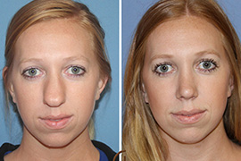 Female-Rhinoplasty-Surgery, Face, Nose and eyes, Rhinoplasty Surgery in Lahore