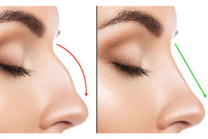 nose Rhinoplasty Surgery in Lahore