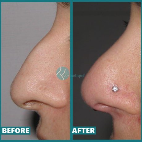 rhinoplasty before after